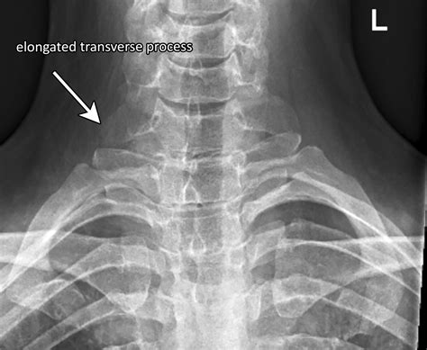 Anatomical anomaly discovered at neurogenic thoracic outlet surgery: a ...