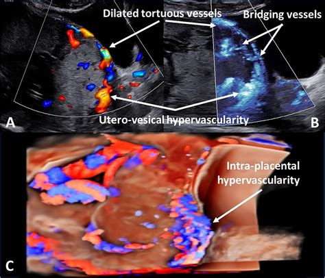 Placenta Percreta Ultrasound