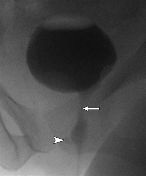 Pre- and Postoperative Evaluation of Urethral Diverticulum | AJR