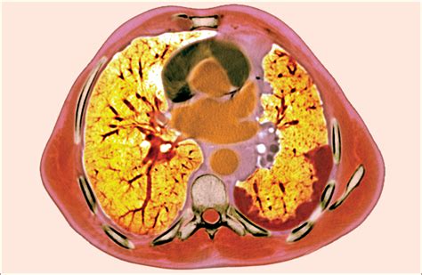 Spindle Cell Sarcoma In Dogs Mouth