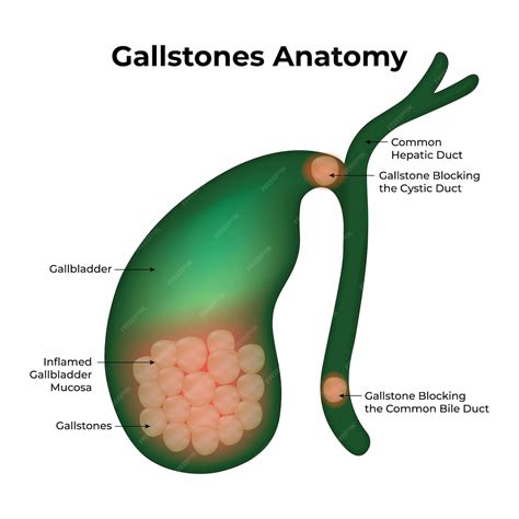 Premium Vector | Gallstones Anatomy Gallbladder hepatic duct mucosa vector illustration