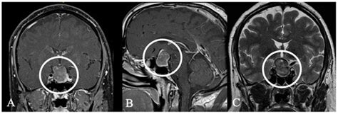 Distinctive Characteristics of Rare Sellar Lesions Mimicking Pituitary ...