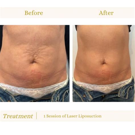 Laser Lipo Before And After