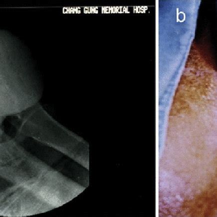 Image result for Normal Intravenous Pyelogram