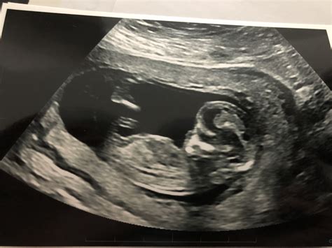 12 Week Ultrasound Pictures