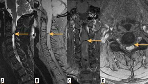 What Is A Tumor Of The Spinal Cord