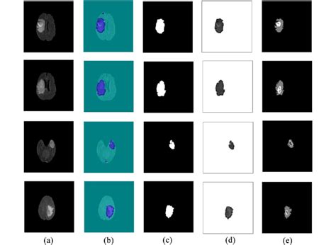 Image result for Tumor Segmentation Using Python