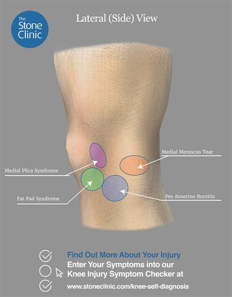 Knee Pain Symptom Checker [Online Knee Injury Self-Diagnosis Tool]