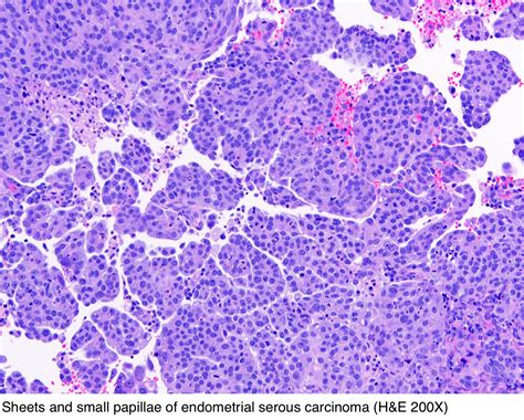 Papillary Serous Carcinoma