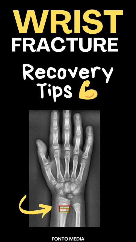 Broken Wrist - Recovery and Healing Time