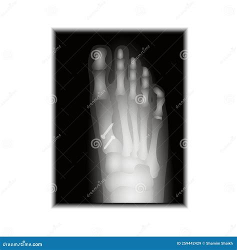 X-ray of Foot - Human Anatomy - Healthcare - Science Stock Illustration - Illustration of foot ...