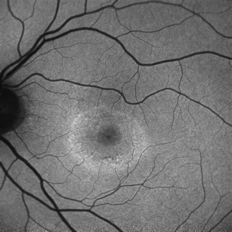 Moran CORE | Bilateral Bull’s Eye Maculopathy