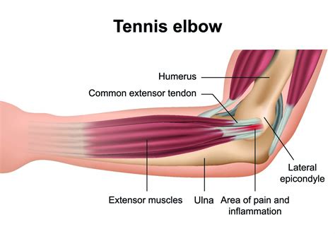 The One Tool You Need to Relieve Tennis Elbow Pain | Performance Health