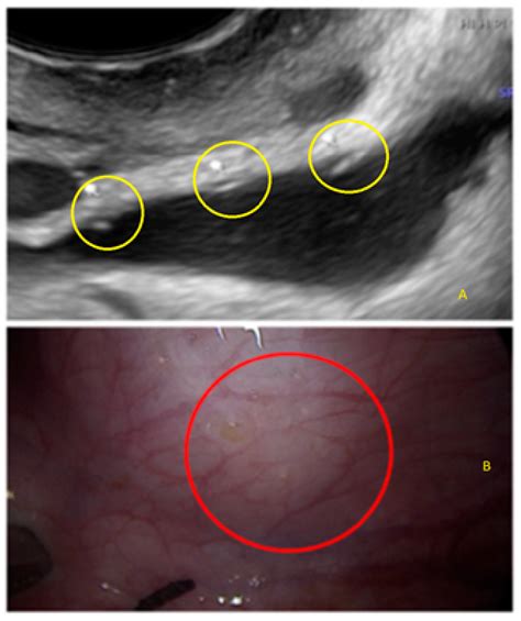 Superficial Endometriosis at Ultrasound Examination—A Diagnostic ...