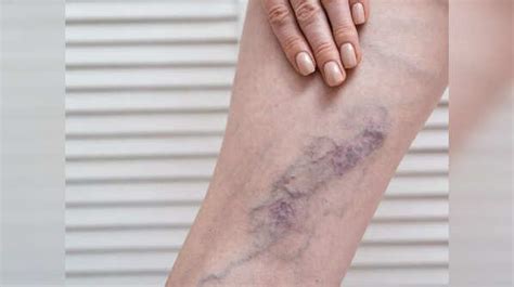 Blood Clot In Leg Symptoms | Deep Vein Thrombosis(DVT): Signs of blood ...