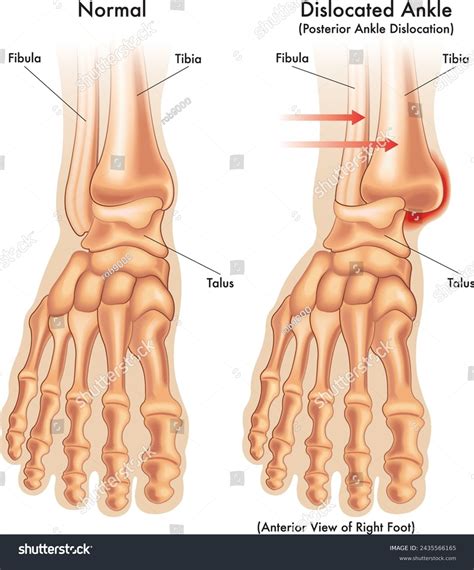 Dislocated Ankle Dislocated Ankle Recovery Time | Elastoplast UK