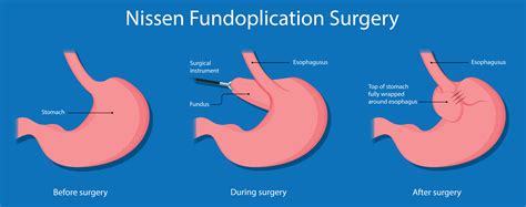 What Is The Newest Surgery For Hiatal Hernia at Anton Washington blog