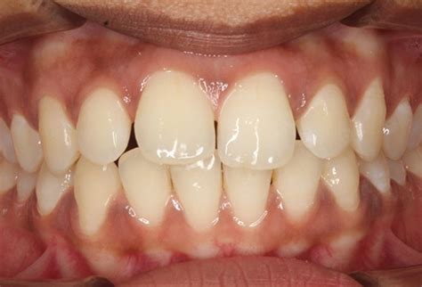 Clear teeth aligner and invisible reviews and testimonials