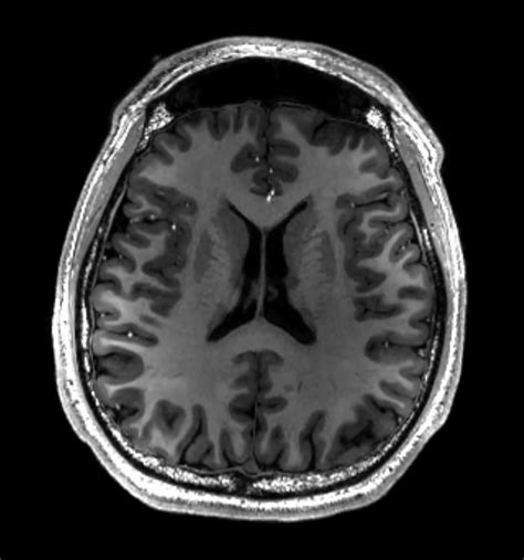 How Your Belly Fat Could Speed Up Brain Aging