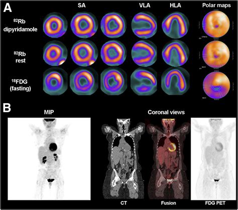 Pet Ct Scan For The Heart at Isabelle Rivers blog