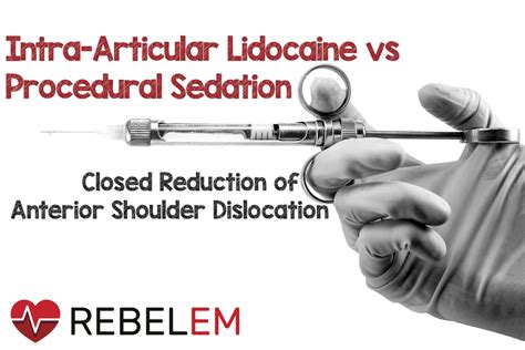 Intra-articular Lidocaine vs Procedural Sedation and Analgesia for Closed Reduction of Acute ...