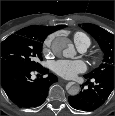 Aortic Dissection | 2016-10-24 | AHC Media:… | Clinician.com