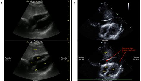 Focused Assessment with Sonography for Trauma (FAST) Exam: Image ...