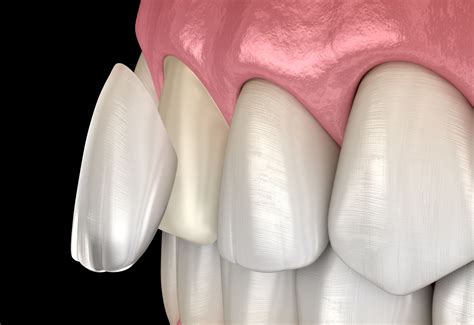 Front Teeth Veneers Procedure at Craig Alston blog