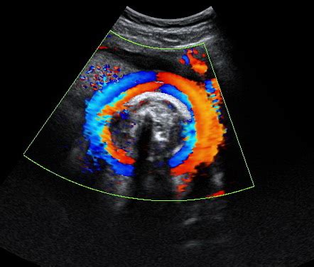 Bildergebnis für umbilical cord abnormalities ultrasound