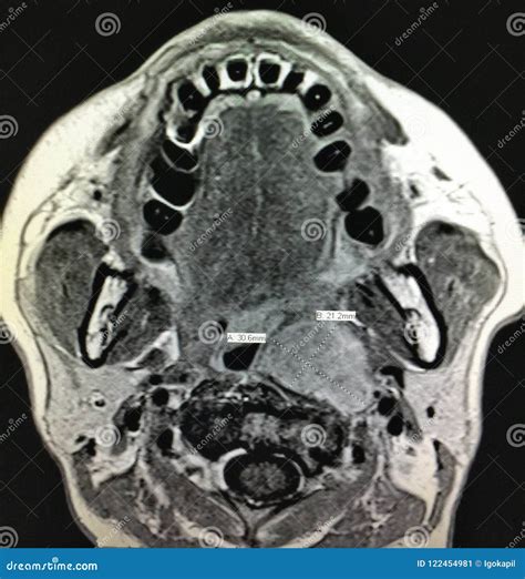 Nasopharyngeal Carcinoma Mri Head Neck Exam Stock Image - Image of invasion, conglomerat: 122454981