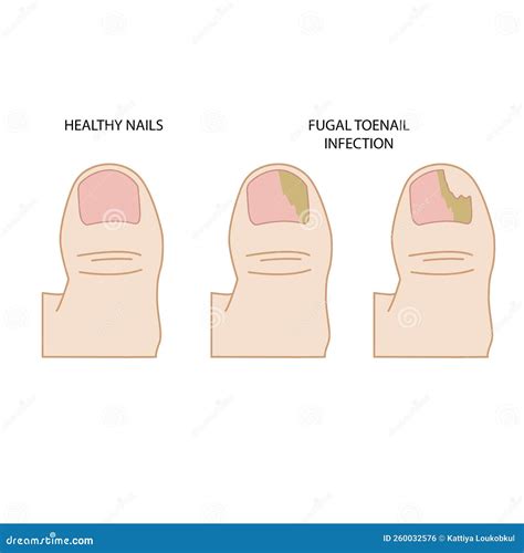 Illustration Of Toenail Fungal Infection