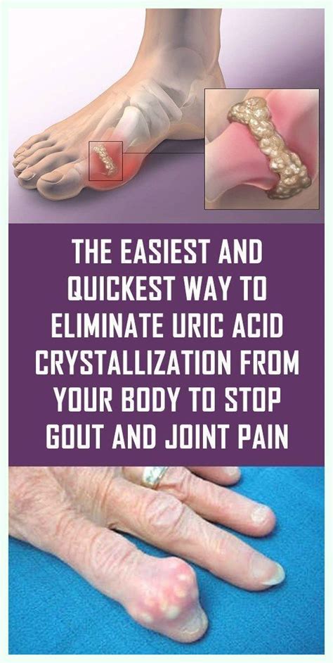uric acid natural remedies