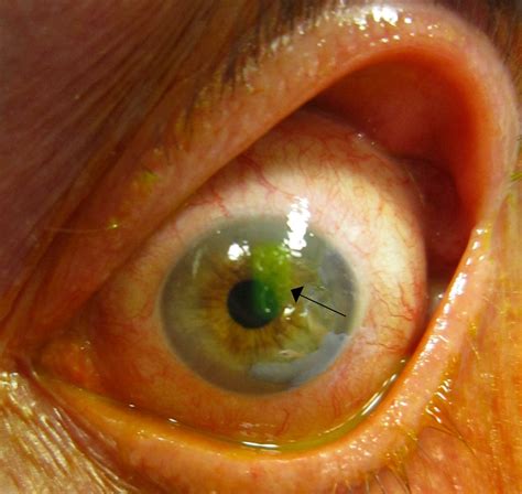 Corneal Abrasions, Erosion, and Ulcers | Concise Medical Knowledge