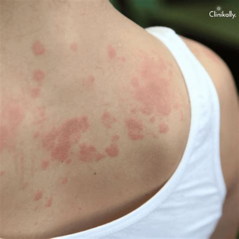 7 Common Skin Rashes Experienced During Travel | Clinikally