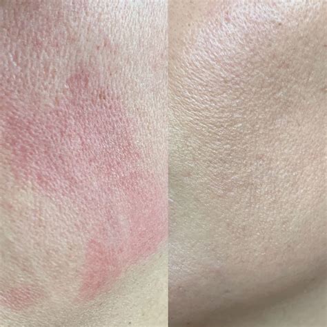 How Can You Tell If Your Skin Is Sensitive, Sensitised, or Reactive ...