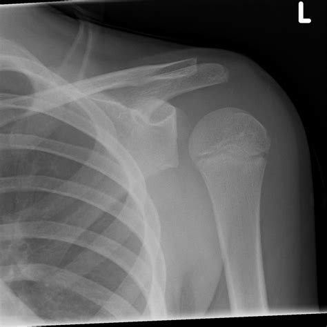 X Ray Of Posterior Shoulder Dislocation at Bruce Earnshaw blog