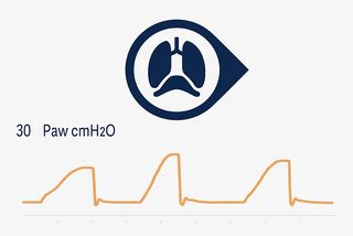 Neural Pressure Support (NPS) - Getinge