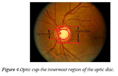 Tilted Optic Disc