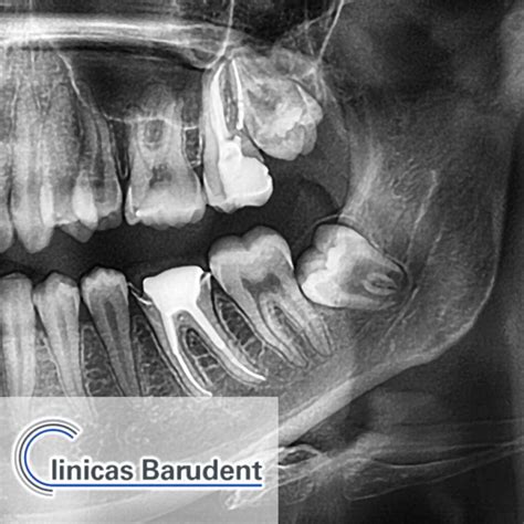 Entendiendo las Muelas del Juicio - Barudent-2024