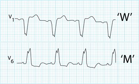 Left Bundle Branch Block (LBBB) • LITFL • ECG Library Diagnosis