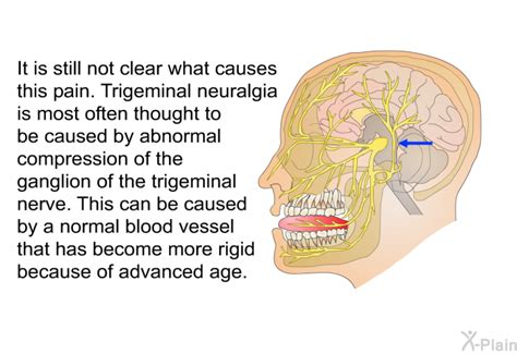 PatEdu.com : Trigeminal Neuralgia - Radiofrequency Rhizotomy