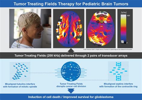 Glioblastoma Electromagnetic Field Therapy at Edward Criss blog