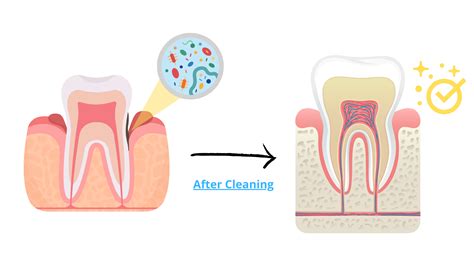 Deep dental cleaning: What you need to know