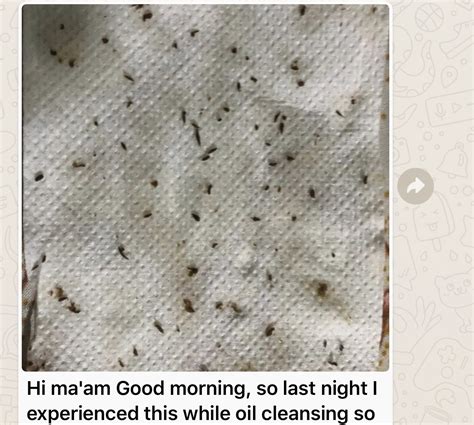 Image result for Sebum Plug Extraction