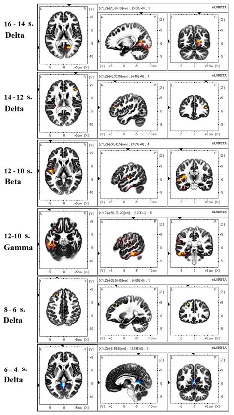 EEG and fMRI Correlates of Insight: A Pilot Study