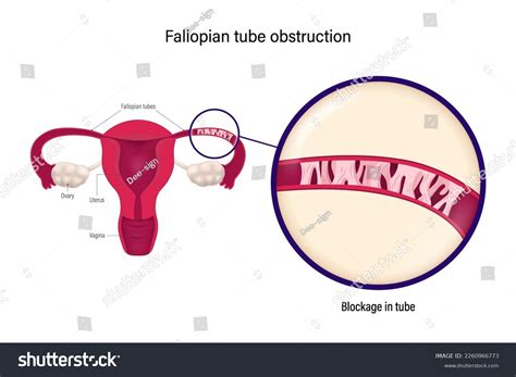 Fallopian Tube Obstruction Block Fallopian Tube Stock Vector (Royalty Free) 2260966773 ...