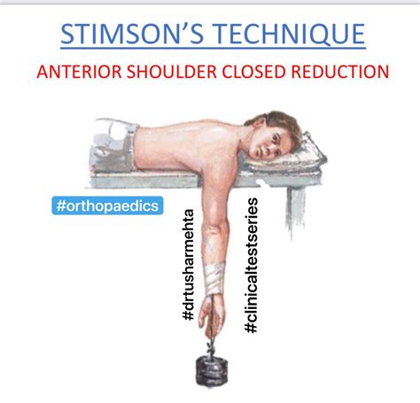 Image result for Shoulder Reduction Methods