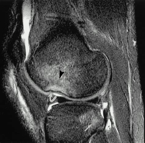 Bone Contusion Patterns of the Knee at MR Imaging: Footprint of the ...