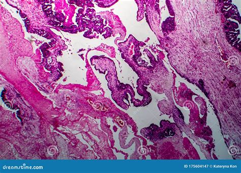 Papillary Serous Ovarian Adenocarcinoma, Light Micrograph Stock Image - Image of histology ...