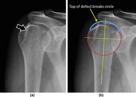 The broken circle method: a novel technique that enhances detection of ...